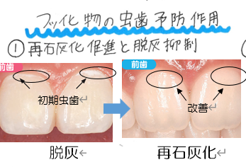 再石灰化促進と脱灰抑制