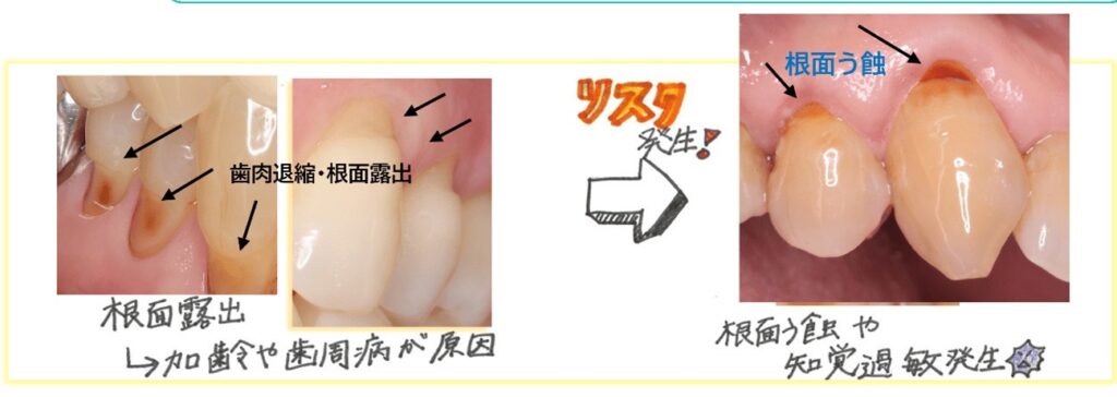 根面露出による虫歯