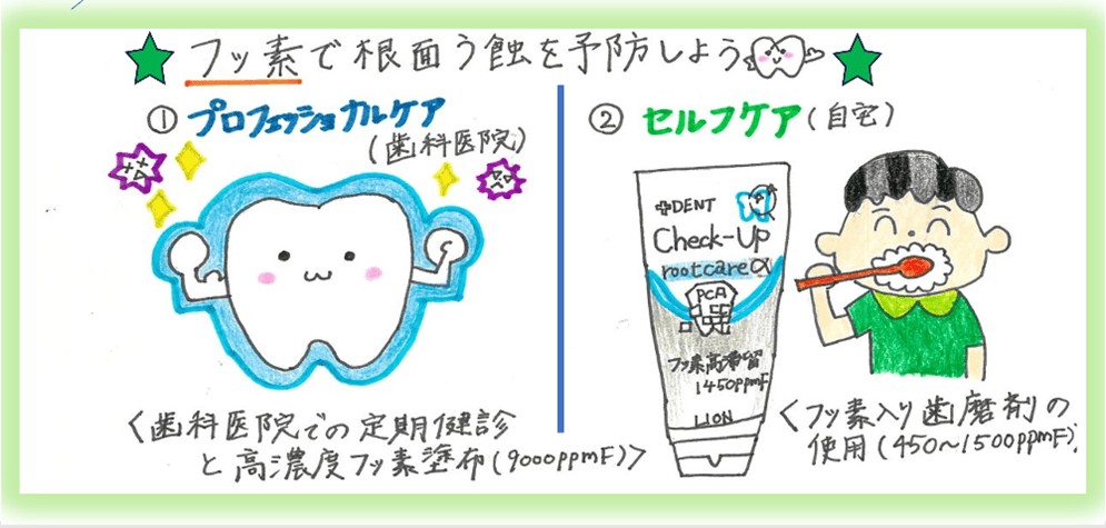 フッ素で根面う蝕を予防