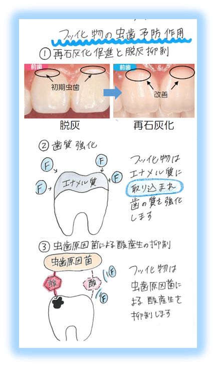 フッ化物の虫歯予防作用